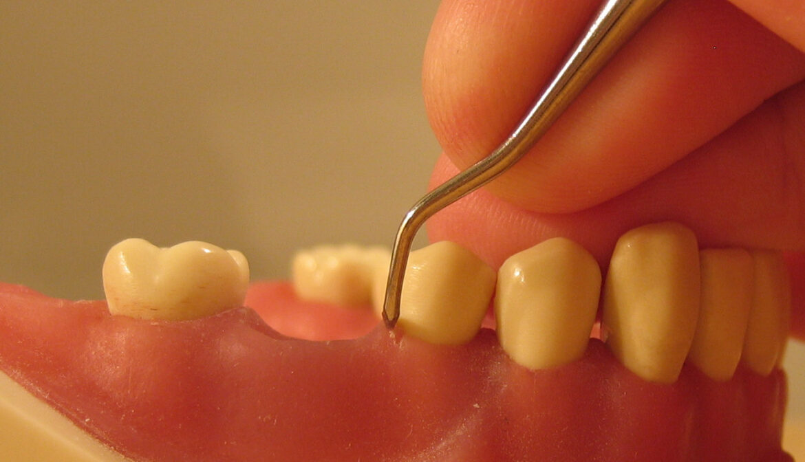 Spacers for Teeth & Periodontal Cleanings the Best Treatment