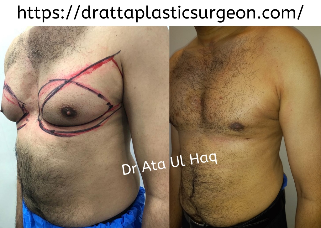 Gynecomastia Surgery in Lahore: Without Surgery Treatment