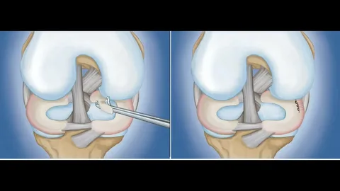 Prevention And Treatment Of Meniscal Cyst
