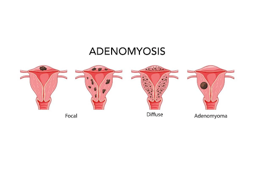 Adenomyosis – Symptoms, Causes, Diagnosis, and Treatments