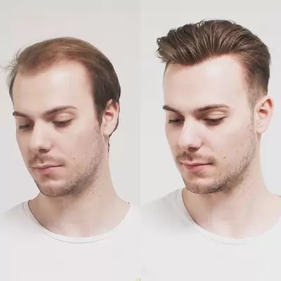 Ultimate Guide to the Best Hair Transplant in Pakistan